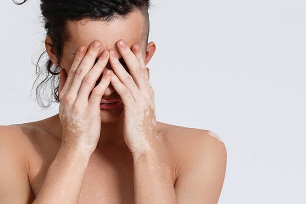 Menjaga Kesehatan Mental pada Penderita Vitiligo Tips dan Strategi